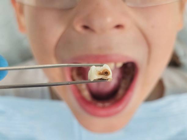Best Emergency Tooth Extraction in Ormond Beach, FL